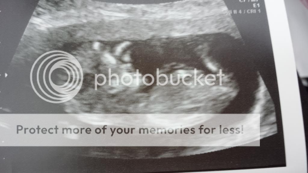 12 Week Scan It s Time For Your Scan Here s What To Expect